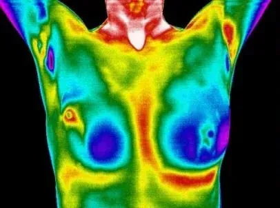 Breast Cancer Screening