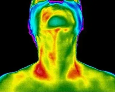 Thyroid Dysfunction Seen Unilaterally