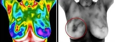 Breast Cancer Screening