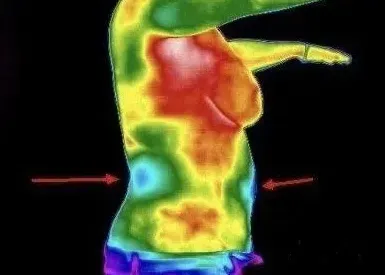 Kidney Cyst Viewed as Hypothermia