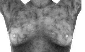 Breast Cancer Screening