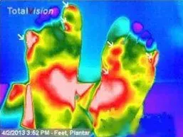Gout in Feet
