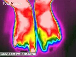 Gout in Feet