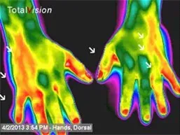 Gout in Hands