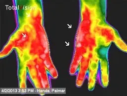 Gout in Hands