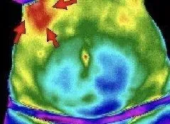 Liver Inflammation Viewed as Hyperthermia