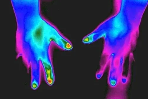 Thoracic Outlet Syndrome Seen as Missing Fingers