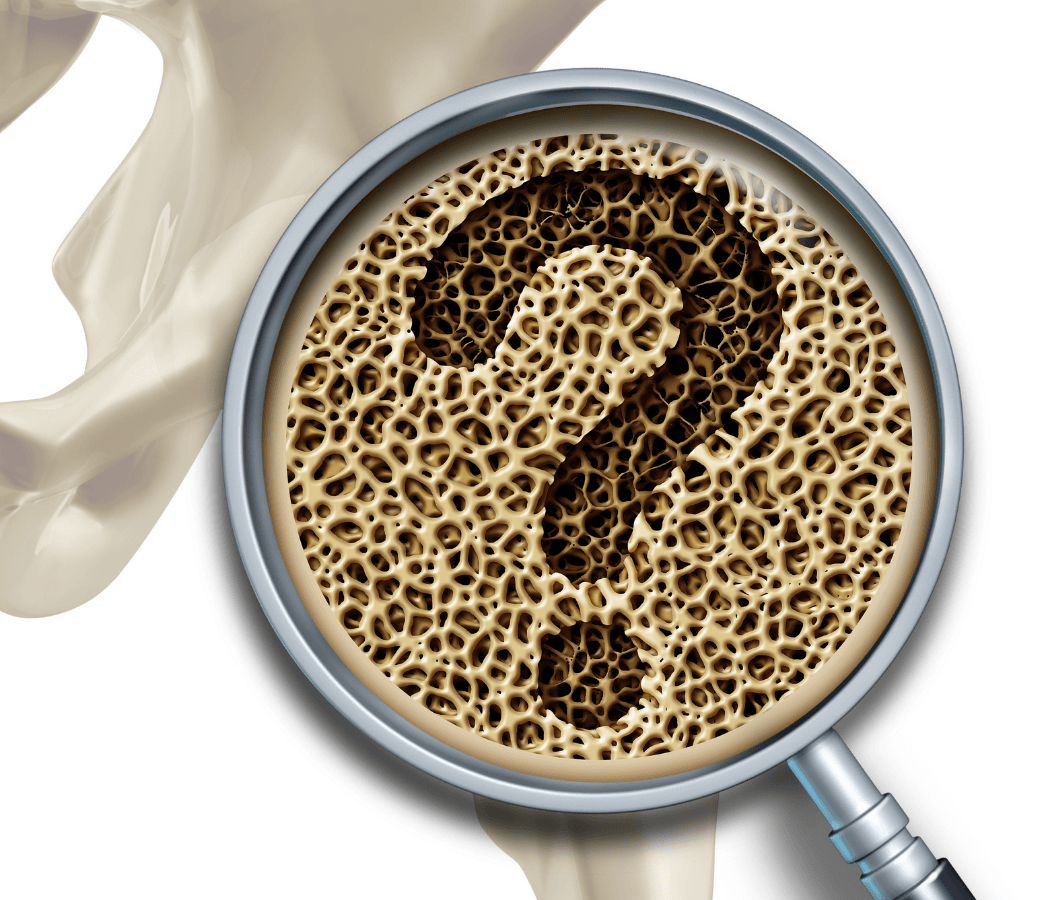 Check-Up OSTEOPOROSI Cagliari