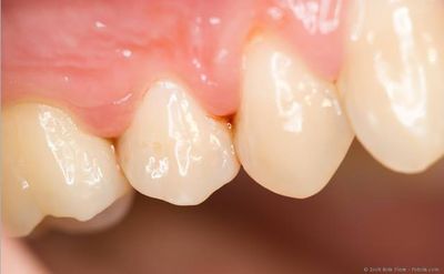 Schon ca. drei Monate nach einer Zahnreinigung können Bakterien im Biofilm der Zahnfleischtaschen zu erneuten Zahnfleischentzündungen führen.