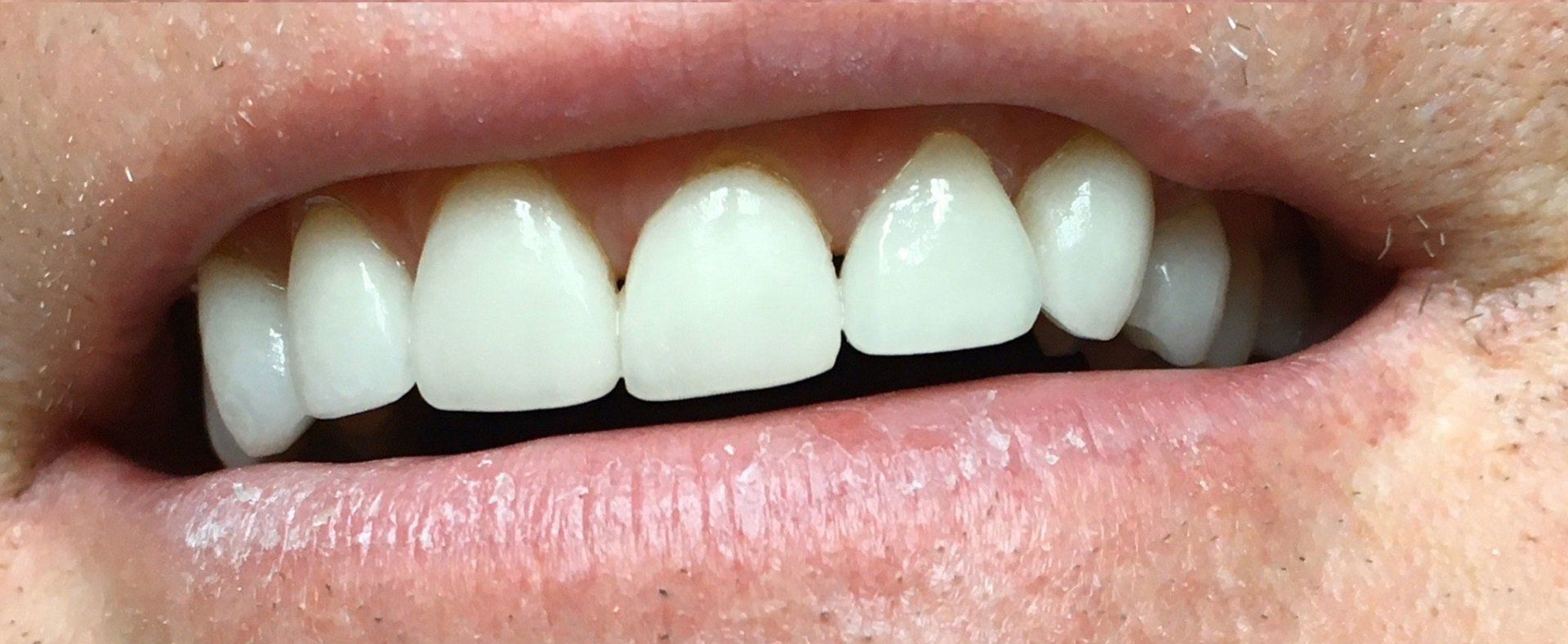 after porcelain crown