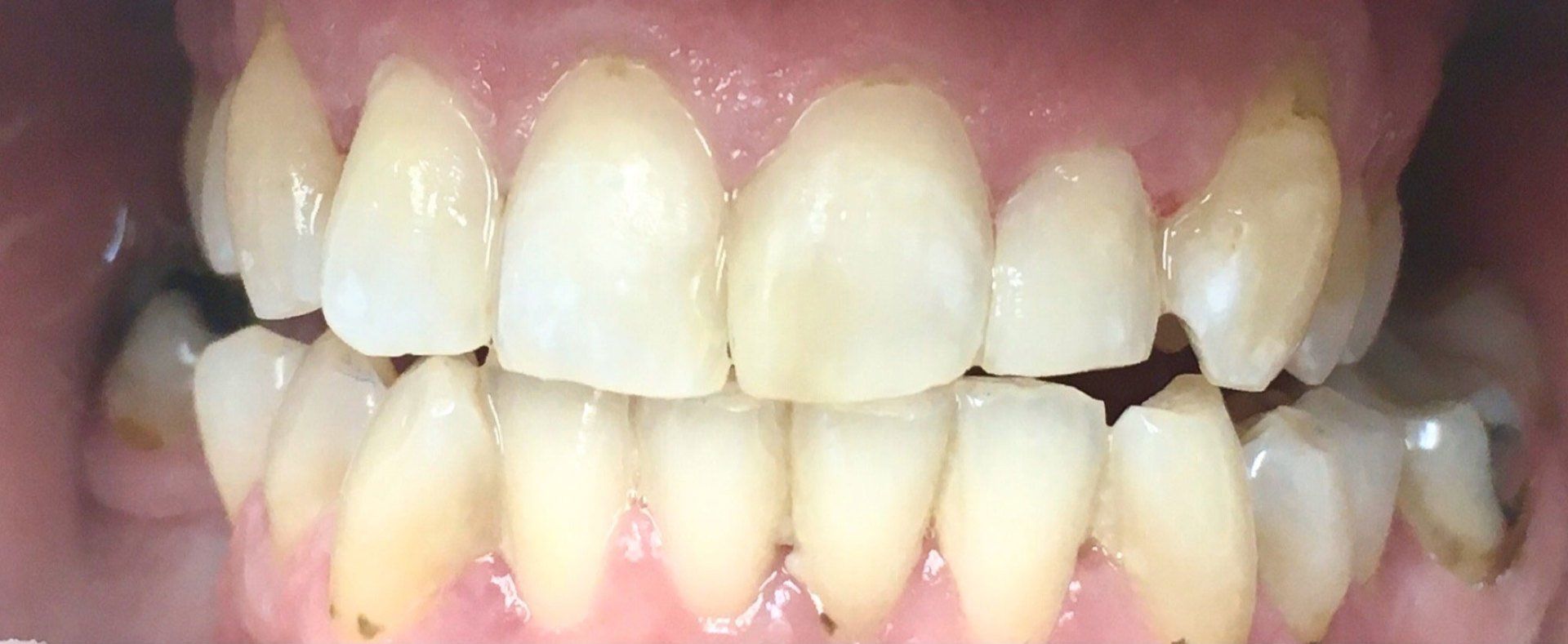 after composite restorations