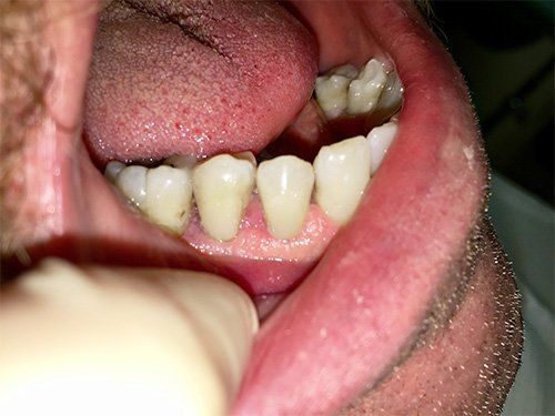 After Composite Restorations