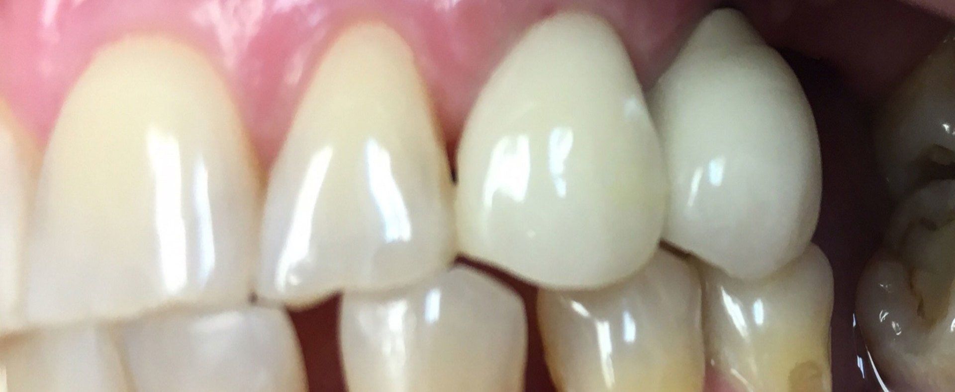 after implant crown