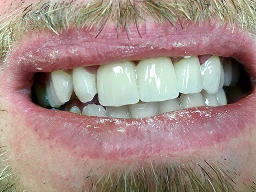 After Anterior Bridge