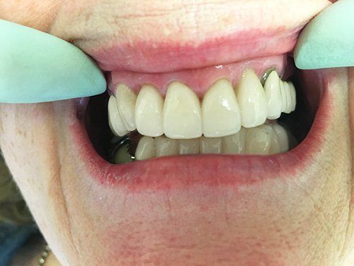 After Dental Crowns patient 2