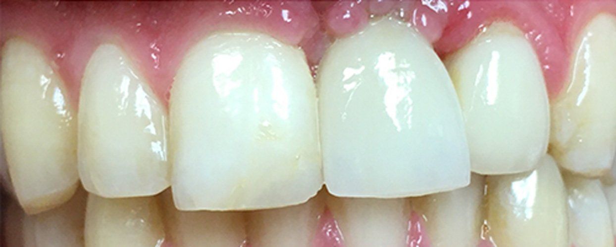 After implant crown