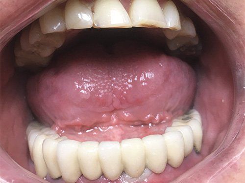After lower implant bridge
