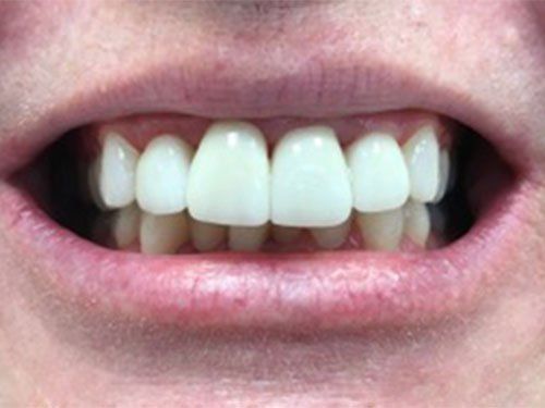 After porcelain and crowns