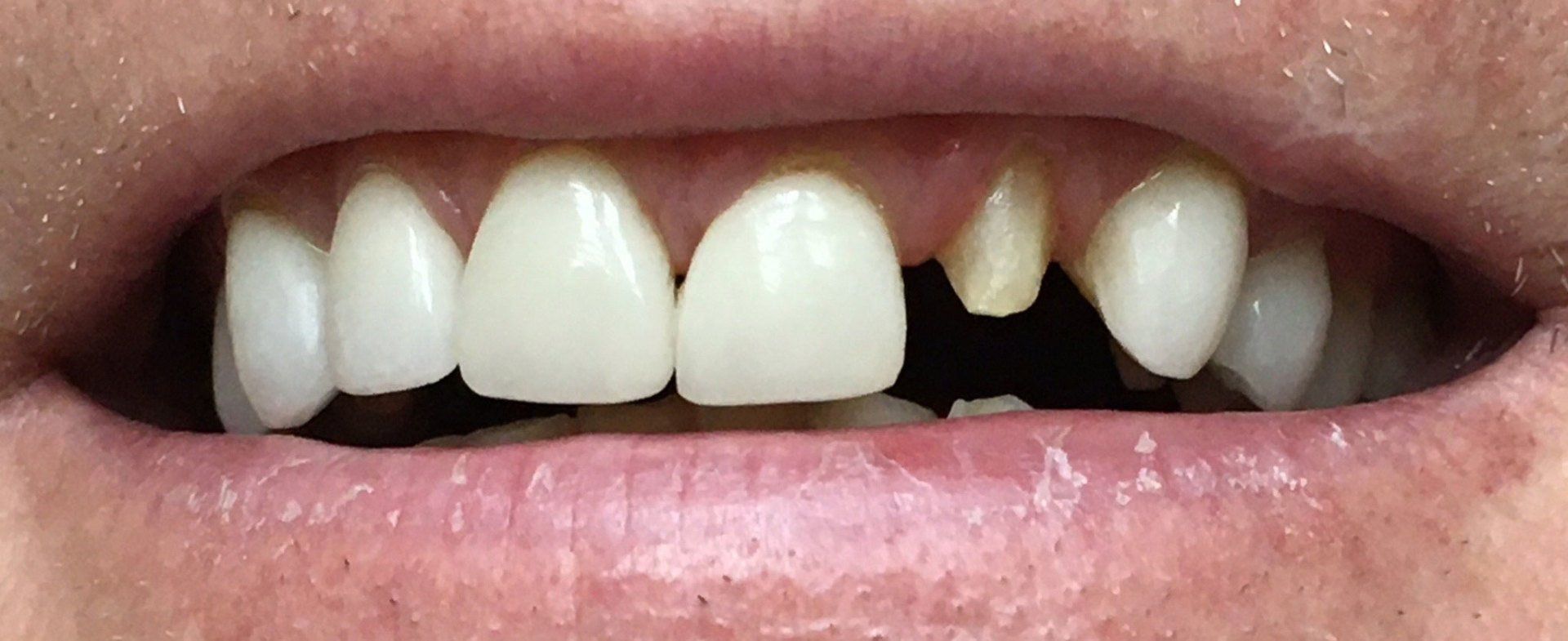 before porcelain crown