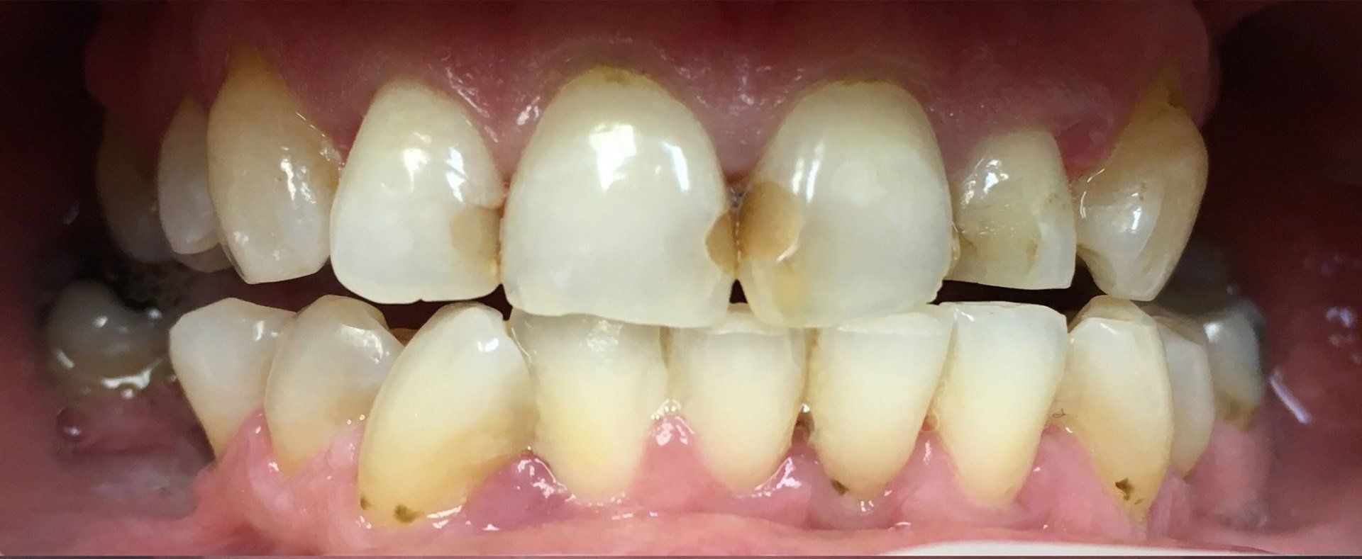 before composite restorations
