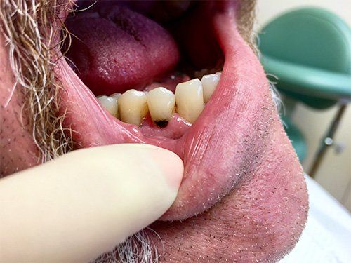 Before Composite Restorations