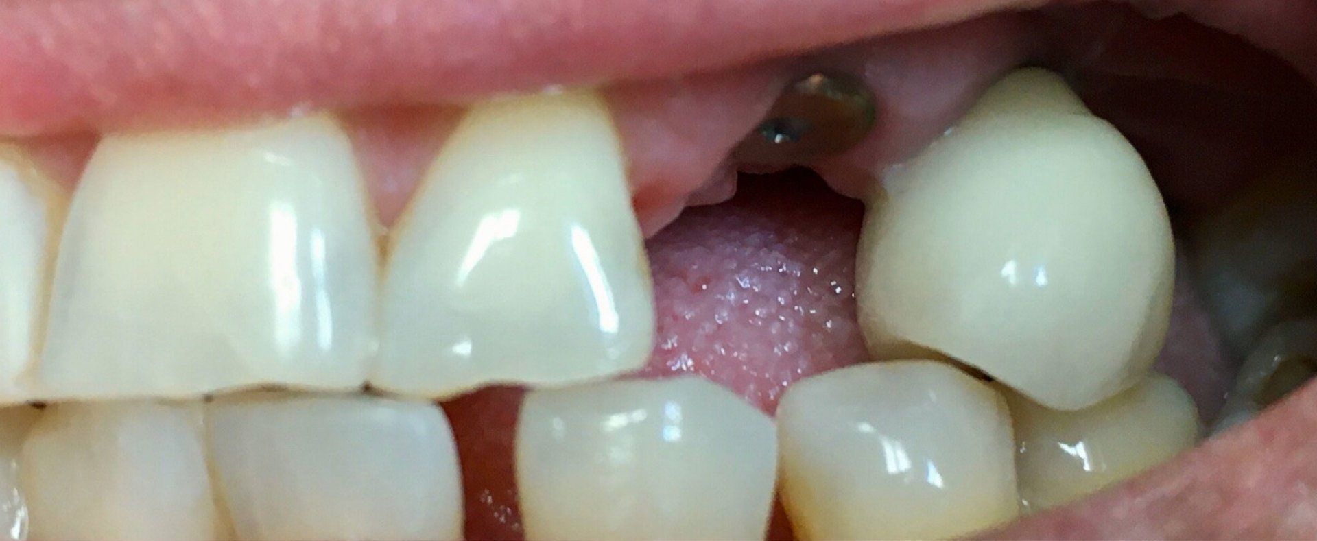 before implant crown