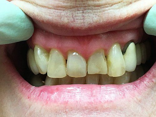 Before Dental Crowns patient 2