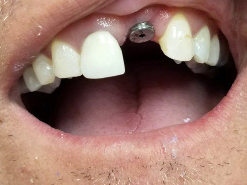 Before Front Tooth Implant