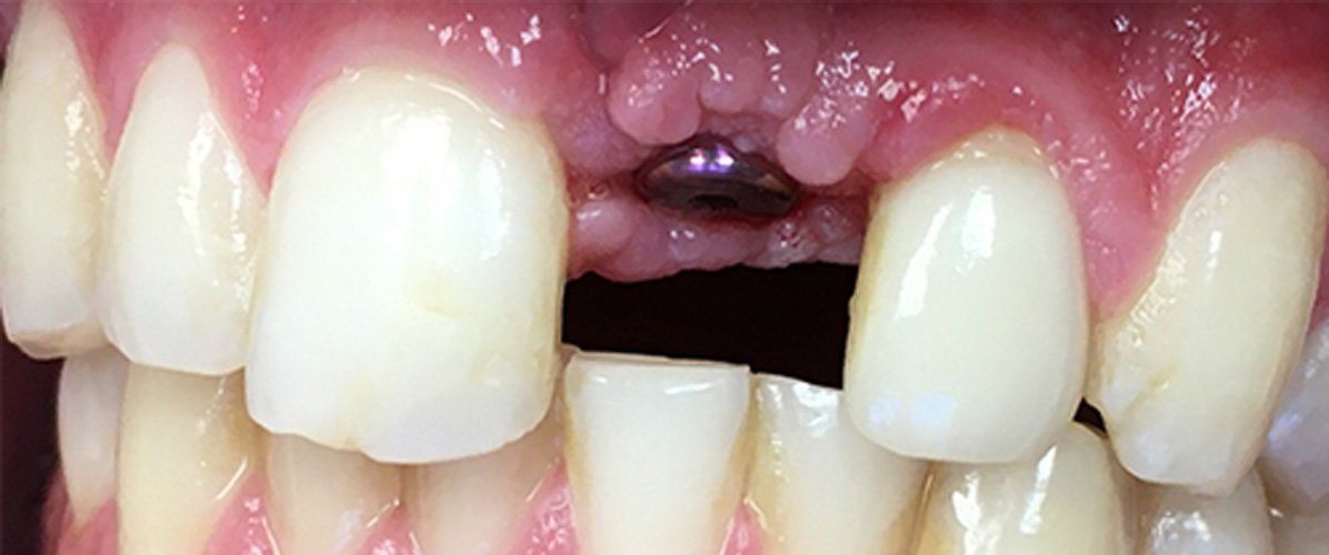 Before implant crown