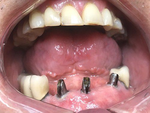 Before lower implant bridge
