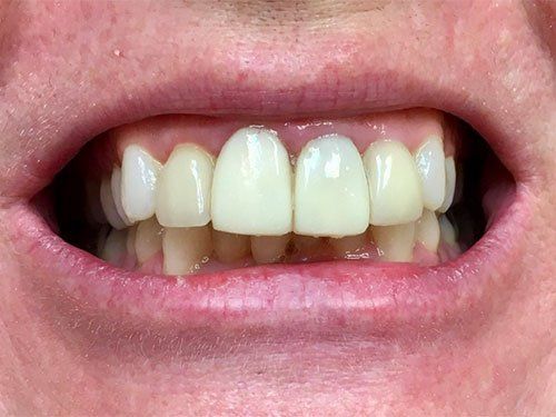 Before porcelain and crowns