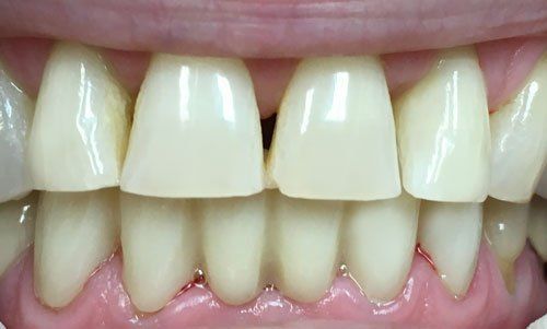 After porcelain lower anterior bridge