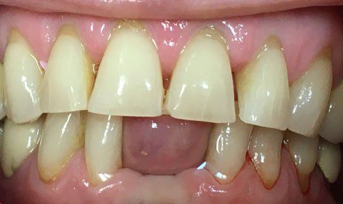 Before porcelain lower anterior bridge