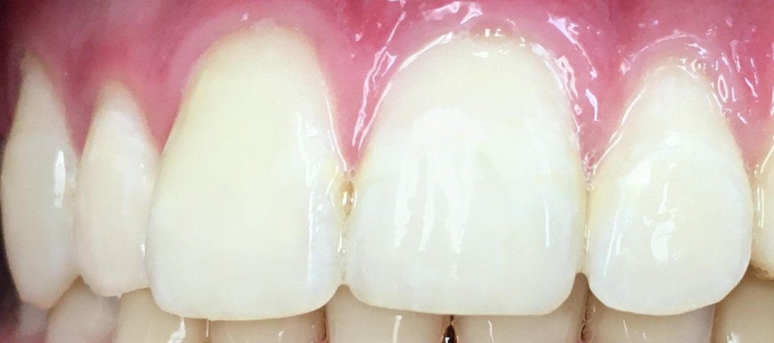 After Restore staining