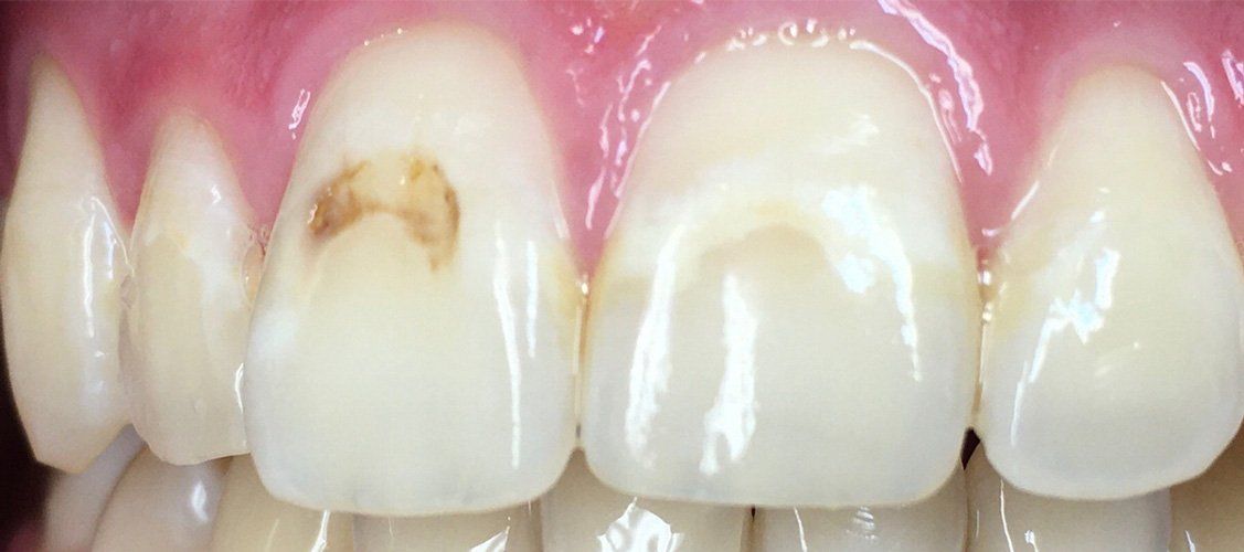 Before Restore staining