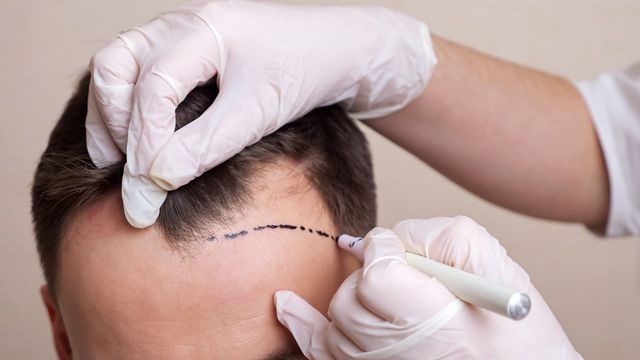 How FUT Hair Transplants Can Give You Your Hair Back | Dr Cotterill