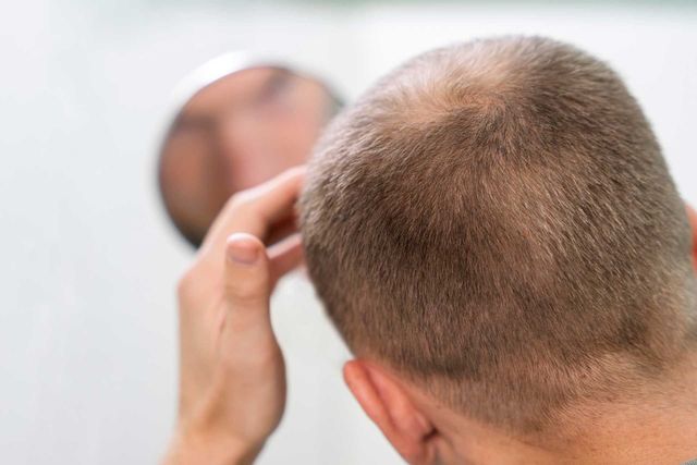 Male Hair Transplant | Dr Paul Cotterill