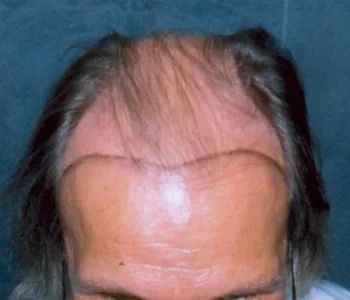 A close up of a person 's forehead with a few hairs on it.
