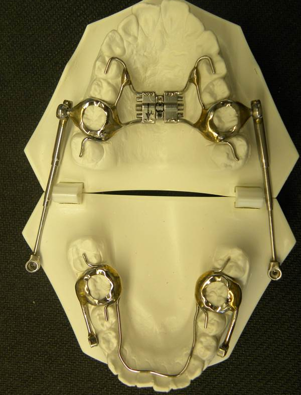 Orthodontic Appliances Sydney, NSW Macono Orthodontic & Dental