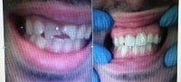 uneven teeth grown treatment — Dentistry in Terre Haute, IN