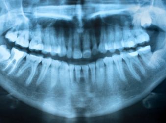 Dental X-Ray - Teeth Whitening in Terre Haute, IN