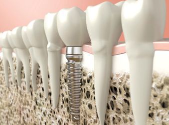 Dental Implant - Orthodontics Dentists in Terre Haute, IN