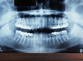 Teeth X-Ray - Orthodontics Dentists in Terre Haute, IN