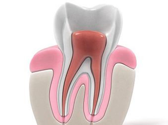 Root Canal Procedure - Orthodontics Dentists in Terre Haute, IN