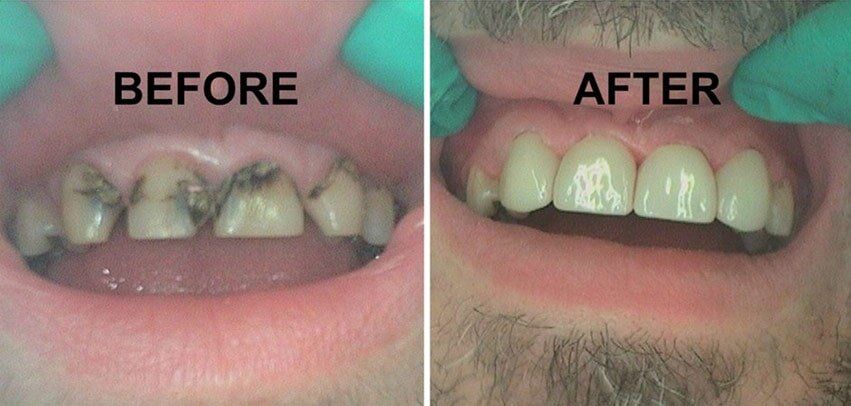 Before and After Teeth Operation — Dentistry in Terre Haute, IN Treatment