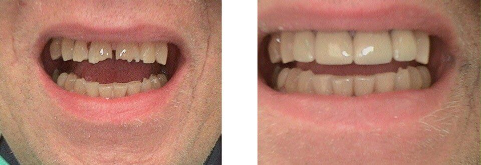 Teeth with irregular grown treatment — Dentistry in Terre Haute, IN