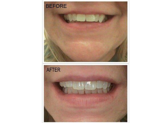 Teeth Correction Alignment Treatment — Dentistry in Terre Haute, IN