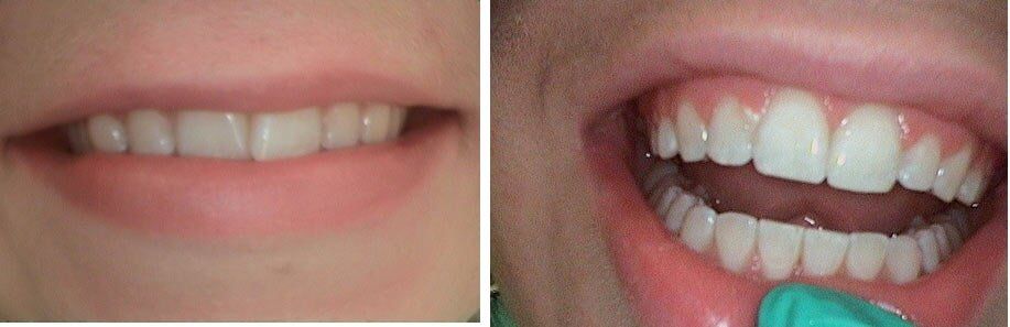White Teeth Cleaning — Dentistry in Terre Haute, IN