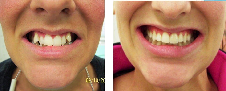 Man undergo with Orthodontics treatment — Dentistry in Terre Haute, IN