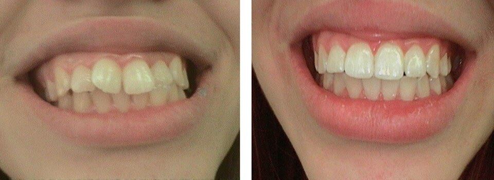 Lady with a big smile after Orthodontics Treatment — Dentistry in Terre Haute, IN